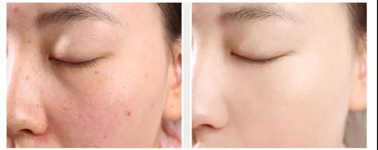 大牌气垫推荐混油皮容易起皮,起皮适合的气垫