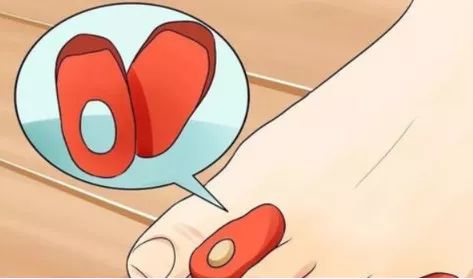 怎么预防跑步起水泡,一到夏天跑步脚就起泡怎么办