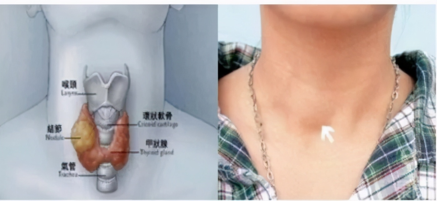 儿童甲状腺弥漫性肿大可早期预防,甲状腺疾病如何通过自检发现