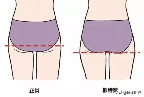 大腿粗，屁股肥，可能是假胯宽！全套矫正方案让你“又窄又瘦”