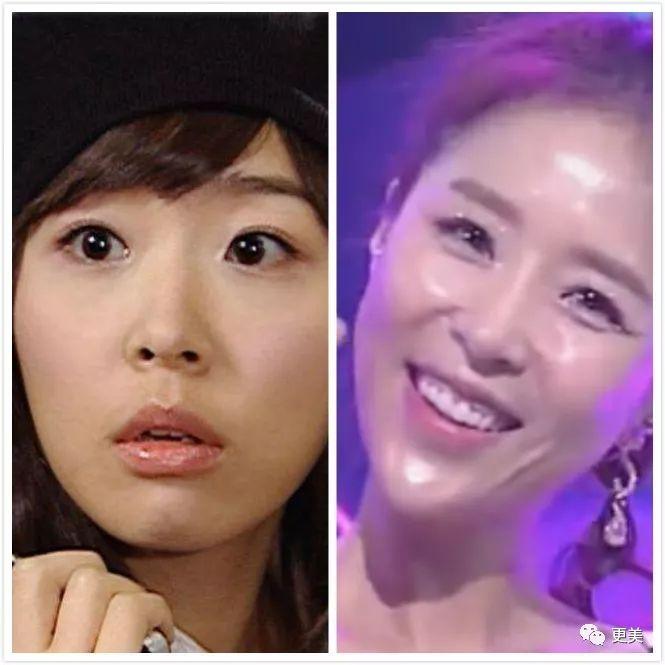 天后因队友吸du人气暴跌，公开承认整形却成蛇精下巴，瘦到脱相