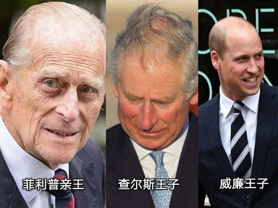 有了这个神器,英国人的脱发有救了?
