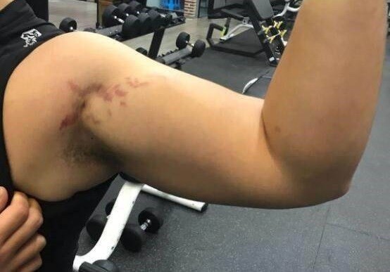 健身之后皮肤出现纹路怎么回事,健身皮肤出现撕裂纹怎么办