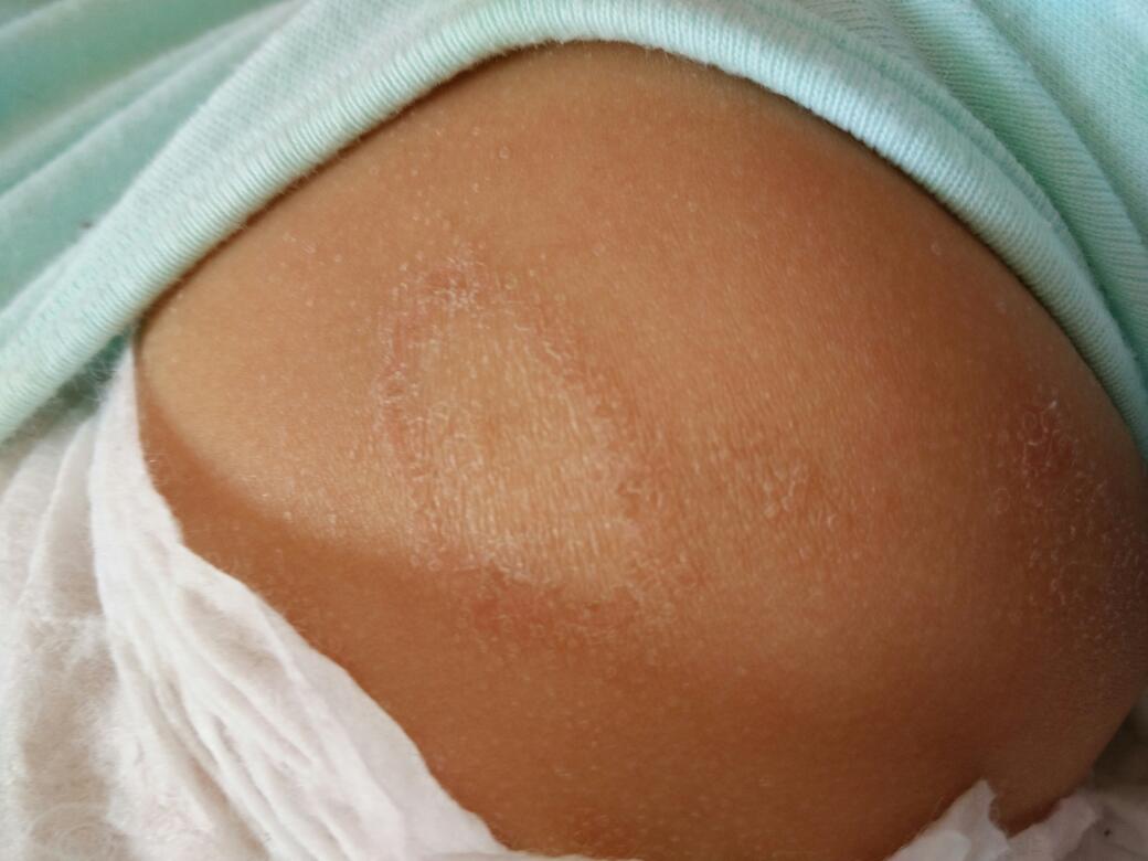 宝宝湿疹反反复复该怎么办,为啥宝宝湿疹反反复复的