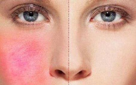 敏感肌肤用什么药膏,敏感肌肤要用什么护肤品比较好