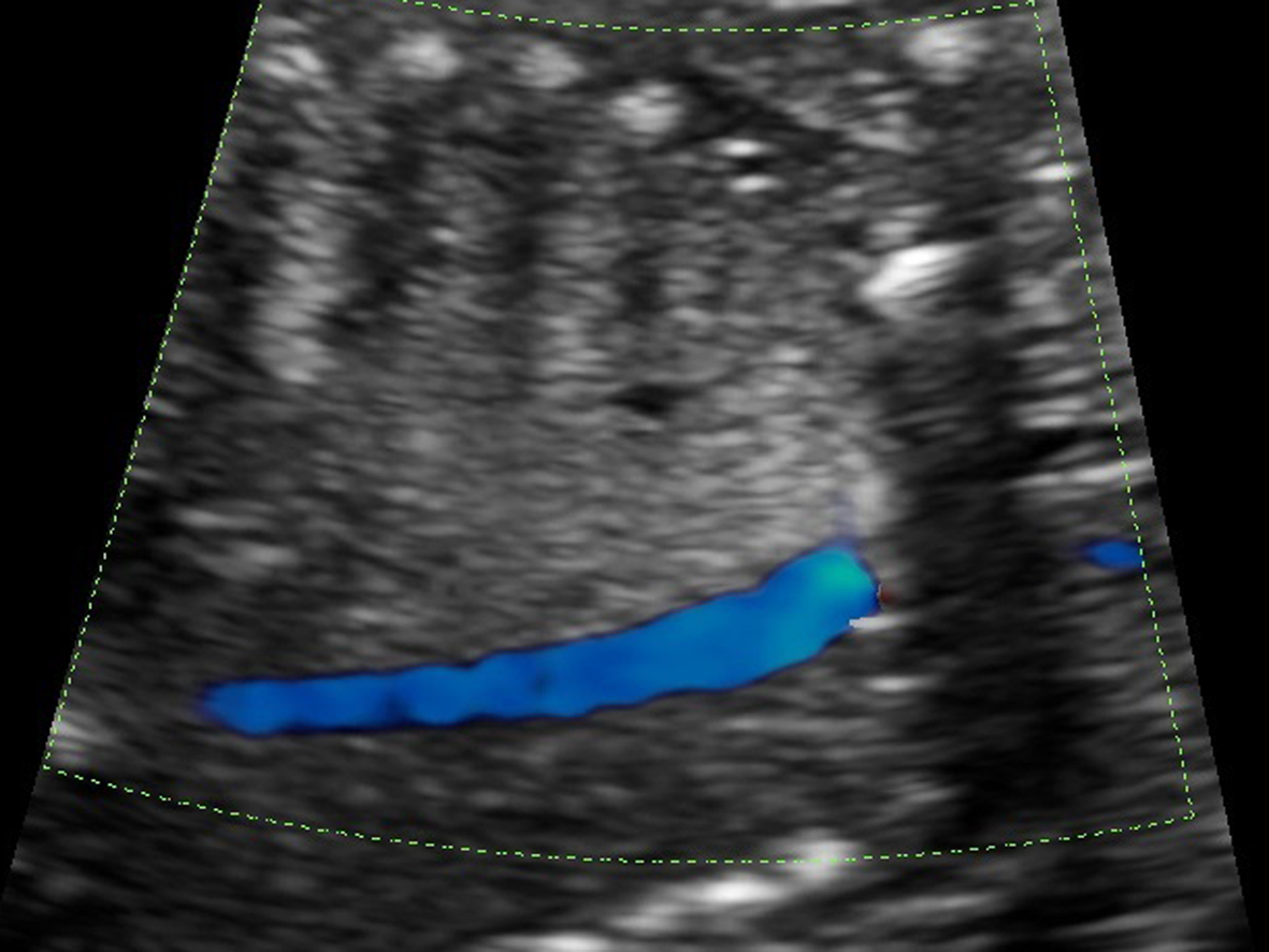 超声检查可以看到胎儿肺部吗,针对性胎儿心脏超声检查