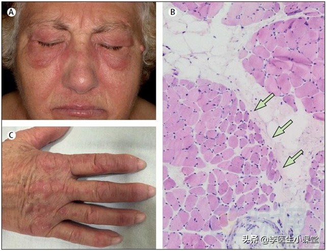 患胃癌前会经历两阶段！在第一阶段改善胃环境，便可逆转癌前疾病