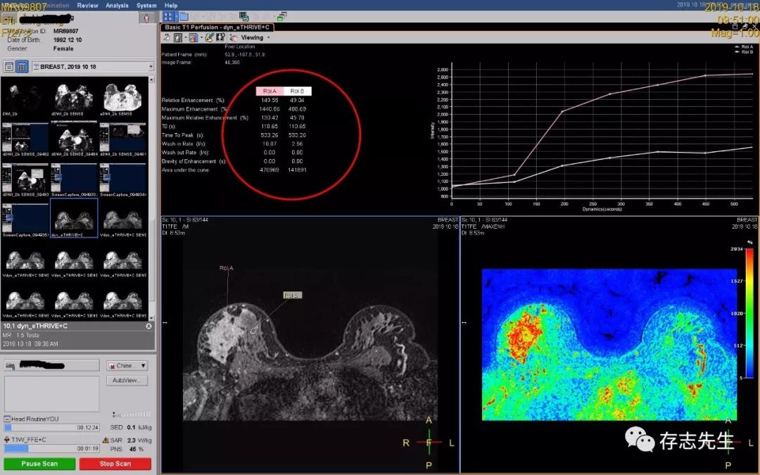 乳腺磁共振亲身经历,磁共振乳腺动态增强扫描全过程
