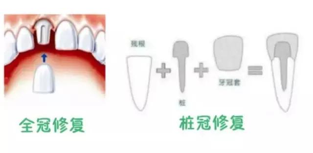 前牙磕掉了一块怎么办？#葉子口腔科普#