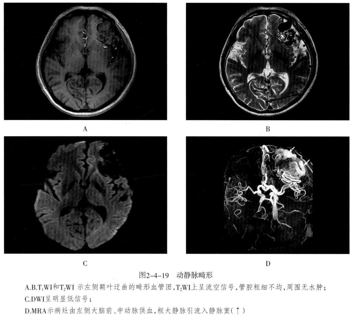 颅内血管轻度狭窄诊断标准,颅内血管先天变异影像