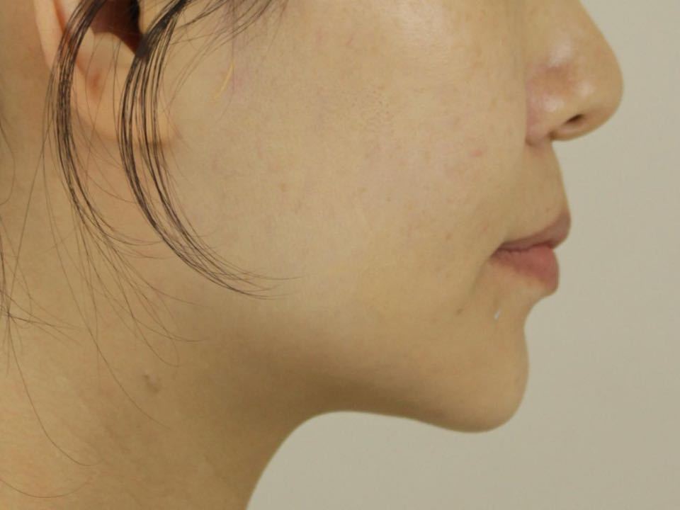 西安张军正畸医生如何,西安牙齿矫正案例