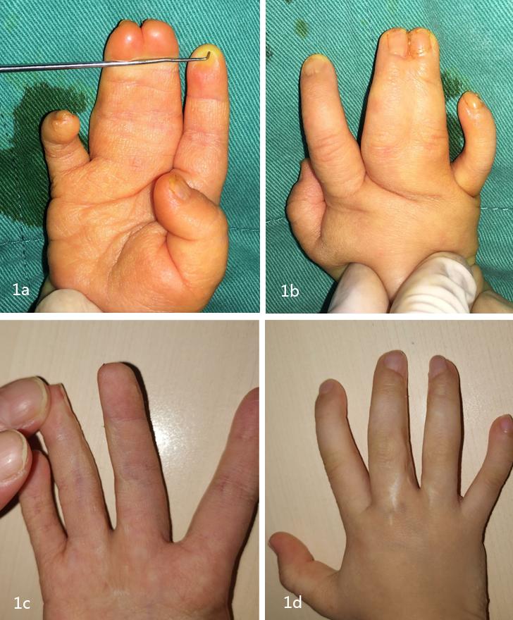 先天性并指畸形科普以及案例分享,先天性并指畸形