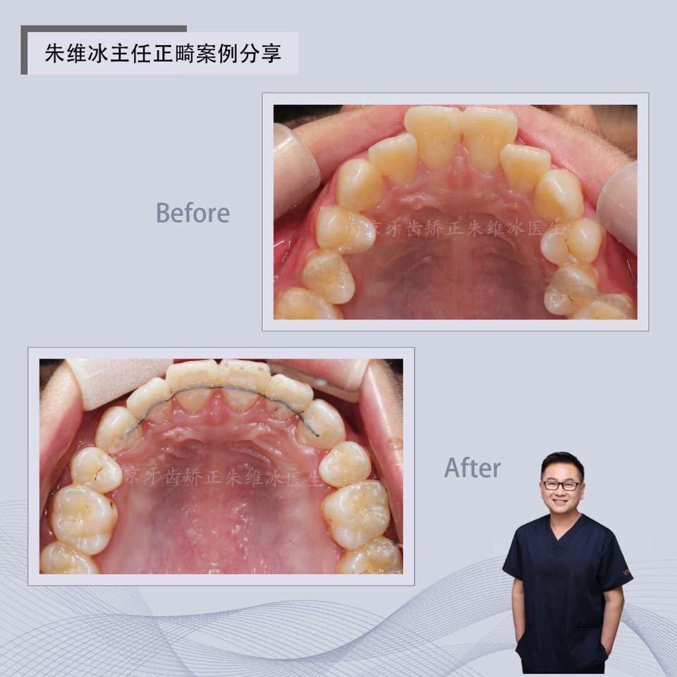 南京正畸朱维冰怎么样,南京牙齿正畸矫正技术