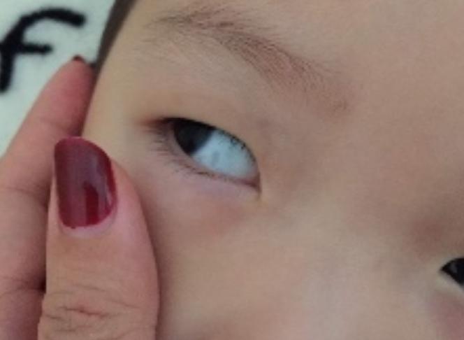 眼白里的小黑斑可以去除吗,宝宝眼白上有小红斑是什么原因