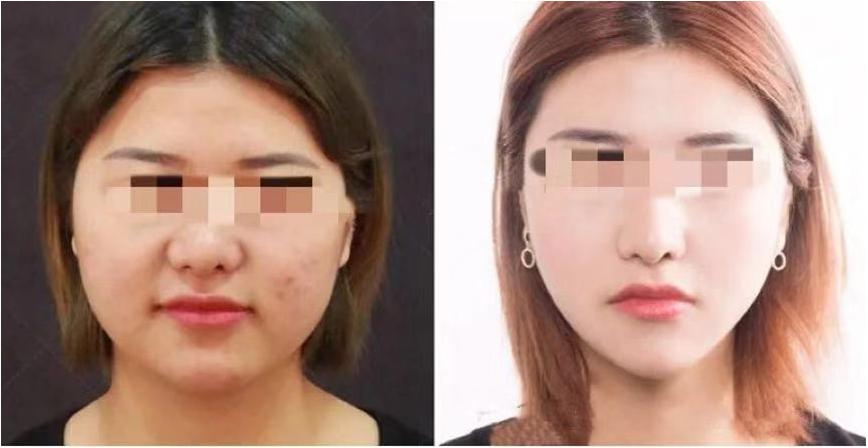 娃娃脸婴儿肥怎么瘦,怎么区分双下巴和婴儿肥