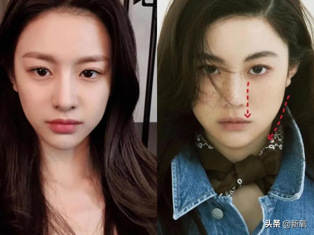 脸松弛下垂做哪种整形,面部下垂整形方法