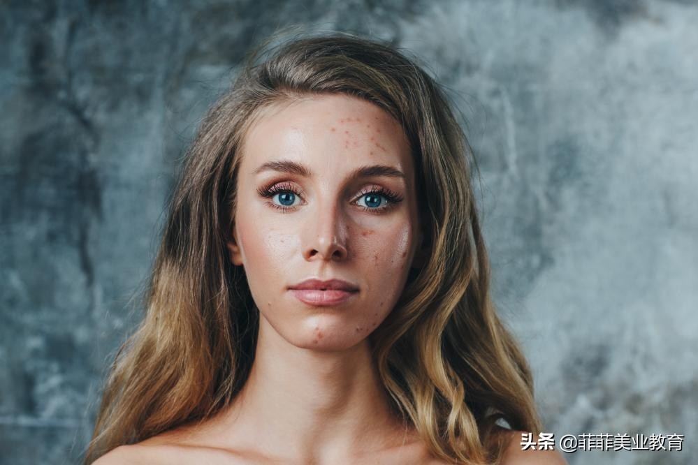 脸老是长痘痘应该用什么护肤品,脸经常长痘怎么护肤