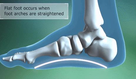 扁平足对运动有什么影响,扁平足适合什么运动项目