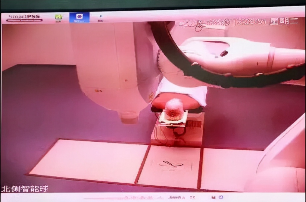 从“将信将疑”到“深信不疑”——射波刀治疗有多神奇