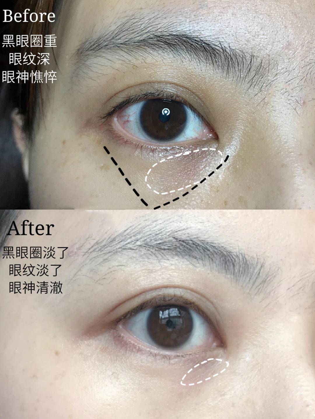 眼部有细纹用眼膜有用吗,眼部细纹眼膜有用吗