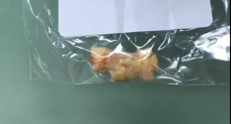 90岁高龄颈动脉重度狭窄血管几近闭塞，年龄大到底能不能做手术？