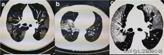 新型冠状病毒肺炎患者的肺,新型冠状病毒患者肺部体征