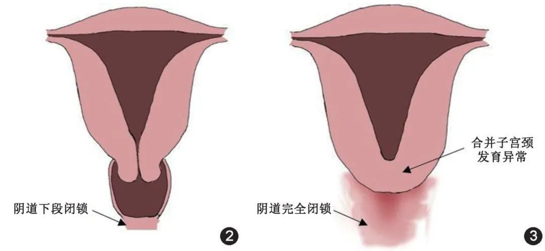 罕见病在抗疫期又遇急情——妙龄少女重获“女儿身”