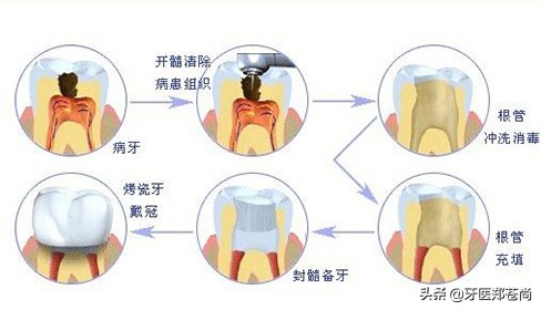 根管治疗牙齿什么样,根管治疗的牙齿是什么