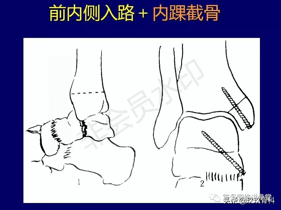 距骨骨折的治疗原则,距骨骨折如何调理