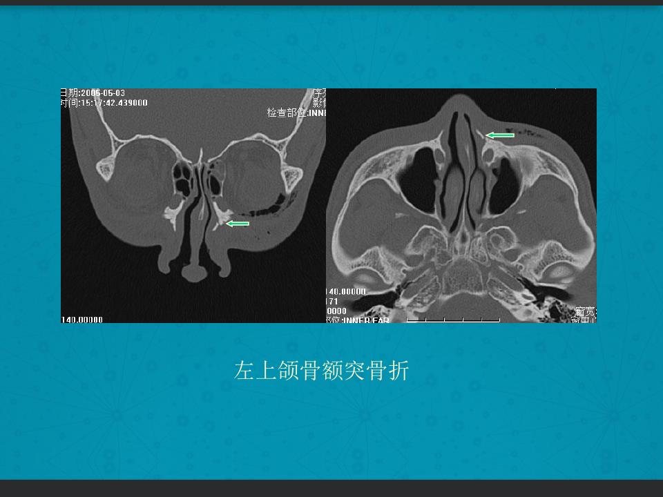 鼻骨骨折复位全过程,诊断证明鼻骨骨折问号是什么意思