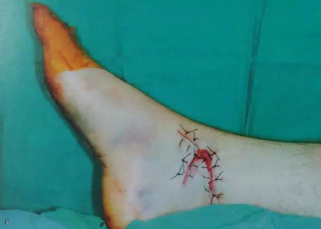 伤口闭合的正确方法,伤口清创的详细步骤