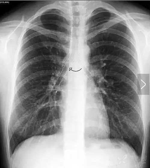 正常胸片图片,正常的胸片讲解