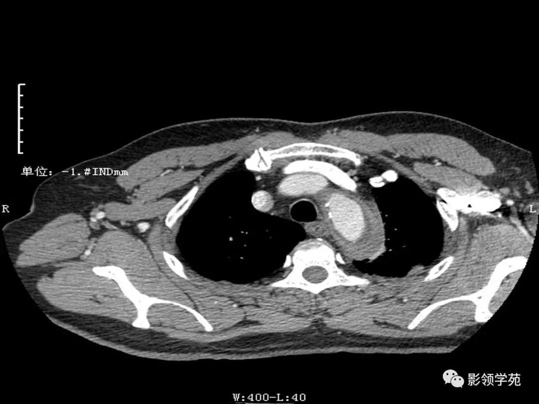 主动脉壁间血肿护理查房,主动脉夹层和壁间血肿图片