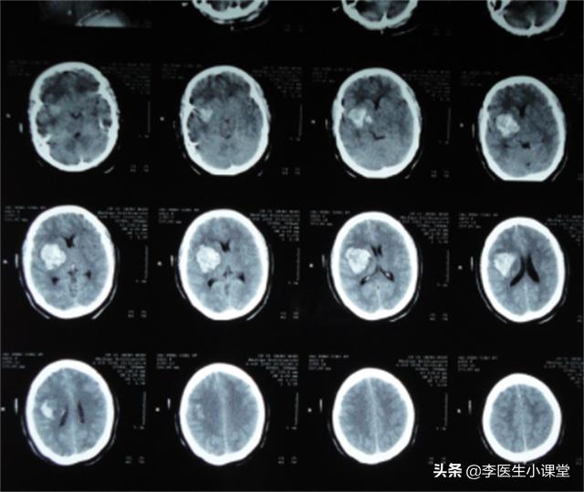 高血压引起脑出血急救方法,高血压脑出血晕倒一小时急救