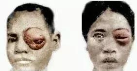 28岁小伙癫痫16年，脑子被虫吃了！竟是爸爸给他吃这个珍稀“大补”！