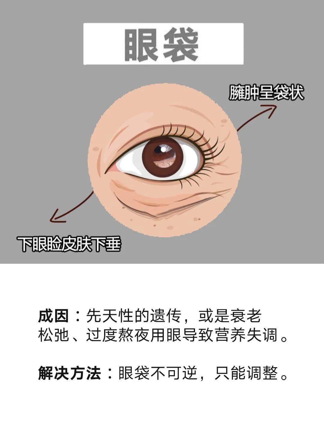 黑眼圈眼袋脂肪粒怎么去除,黑眼圈有纹有脂肪粒用什么
