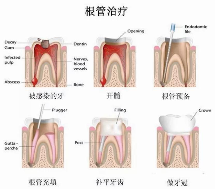 牙齿根管治疗不做牙套是什么样子,牙齿治疗中需要避开的误区
