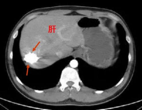 介入疗法值得推广吗,介入治疗是新技术吗