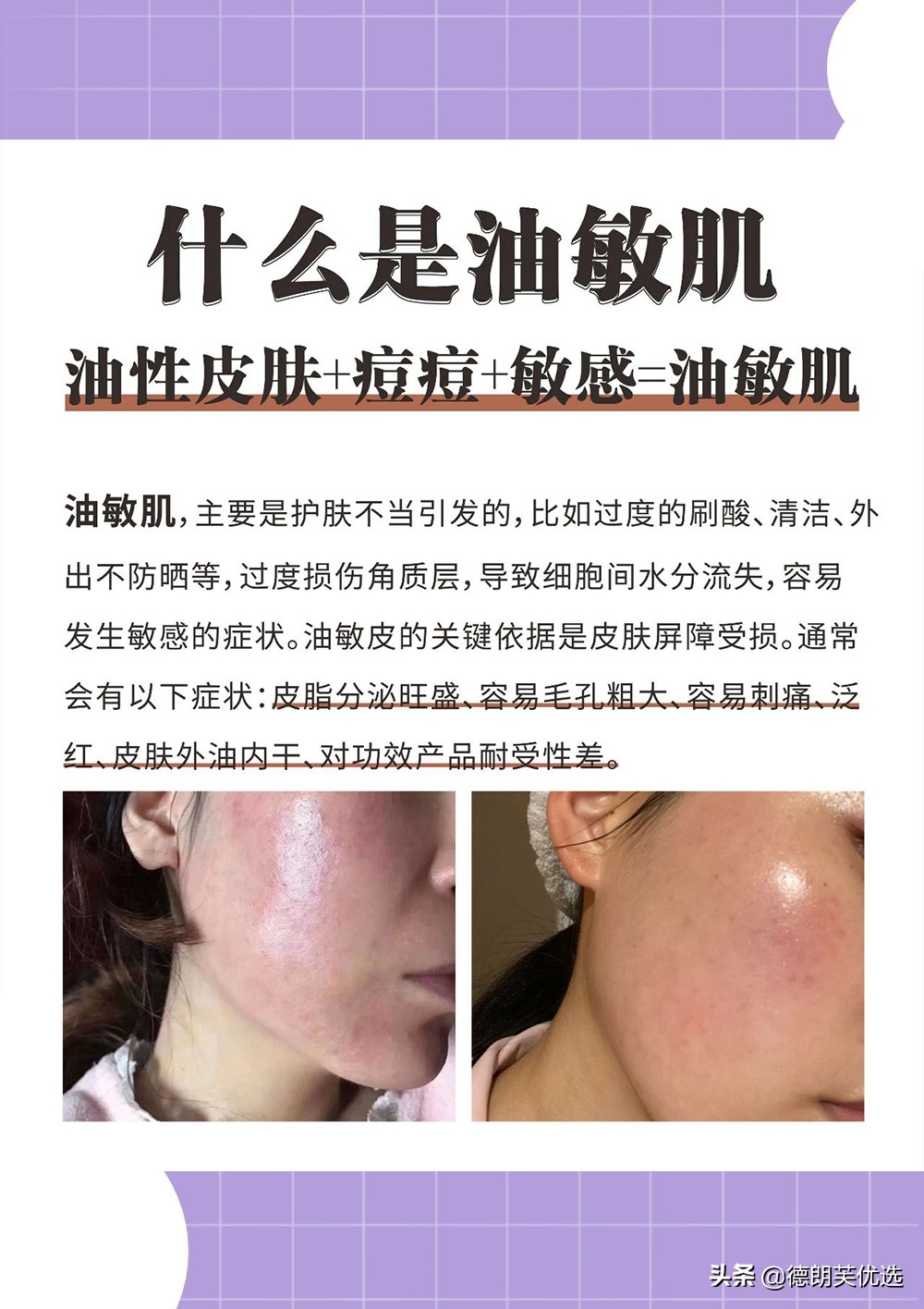 油敏肌脸上突然泛红急救措施,油敏肌饮食上怎么修复皮肤屏障