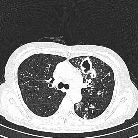 得了肺结核家人怎样预防,家长确诊肺结核对孩子有什么影响