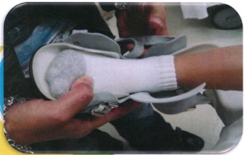 马蹄内翻足的护理有哪些呢,马蹄足内翻矫正支具