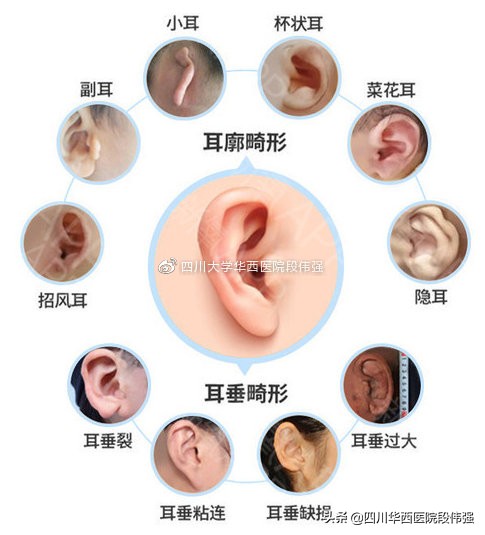 外耳再造三期做完后的效果,外耳再造需要注意什么