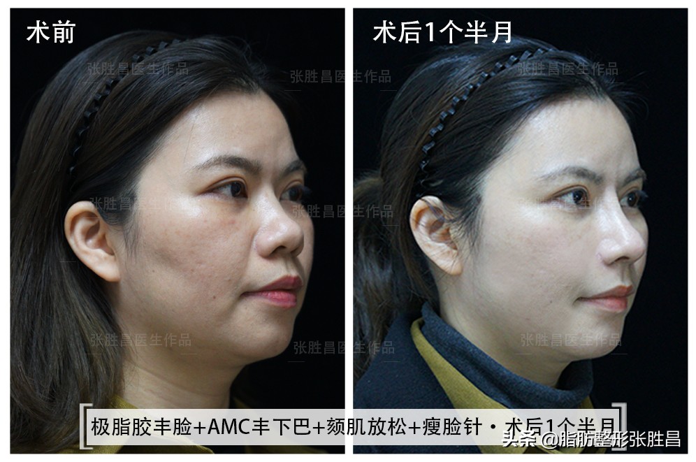 笑久了有法令纹,笑一笑减少法令纹