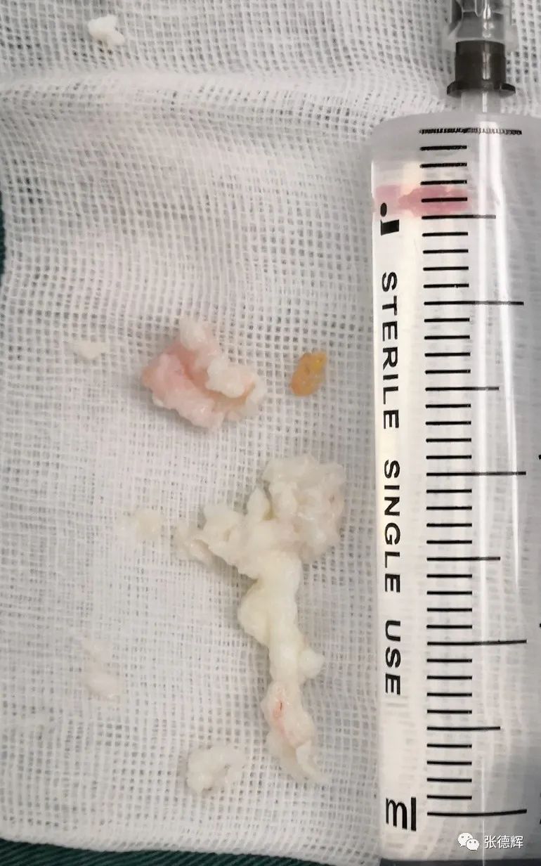 腰椎间盘突出症脊柱内镜微创手术后路镜下视频演示