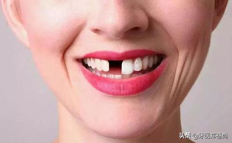 缺失两颗牙修复最佳方式,游离端缺失两颗牙做活动义齿