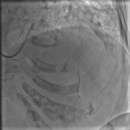 85岁老人心脏堵塞,77岁老人冠脉狭窄放支架还是搭桥