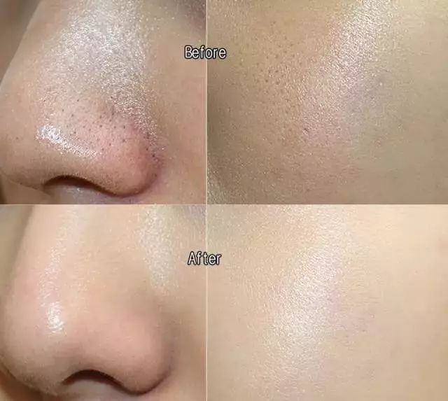 毛孔粗大皮肤暗黄该怎么改善肤质,毛孔粗大肤色暗沉应该怎么改善