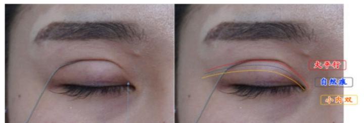 原来双眼皮不好看有必要继续割吗,双眼皮越看越奇怪怎么办