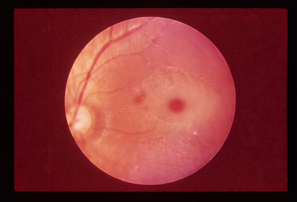 儿童脑白质病变是怎么回事,小脑脑白质海绵状变性综合征