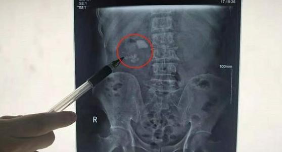 肾结石医生说掉了才手术,肾结石吃什么药溶石快